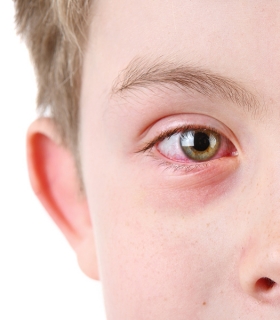 The Many Shades of Pinkeye