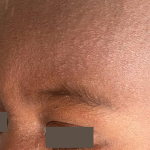 Measles rash on a child's face.
