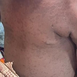 Measles rash on torso of young child.
