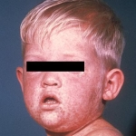 Face of boy after three days with measles rash.