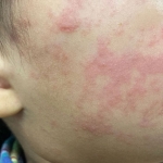 The child’s cheek shows the characteristic rash associated with measles.