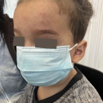 The child’s forehead shows the characteristic maculopapular rash associated with measles.