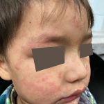 The child’s face and forehead show the maculopapular rash.