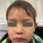 Maculopapular rash on child's face.