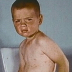 Young boy five to six days into illness with rash and cough.