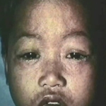 Young, dark-skinned child with watery eyes, runny nose, and raised rash.