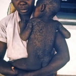 Skin sloughing off of a child healing from measles infection.
