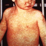 Child with a classic measles rash after four days.