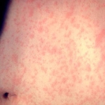 Skin of a patient after three days with measles rash.